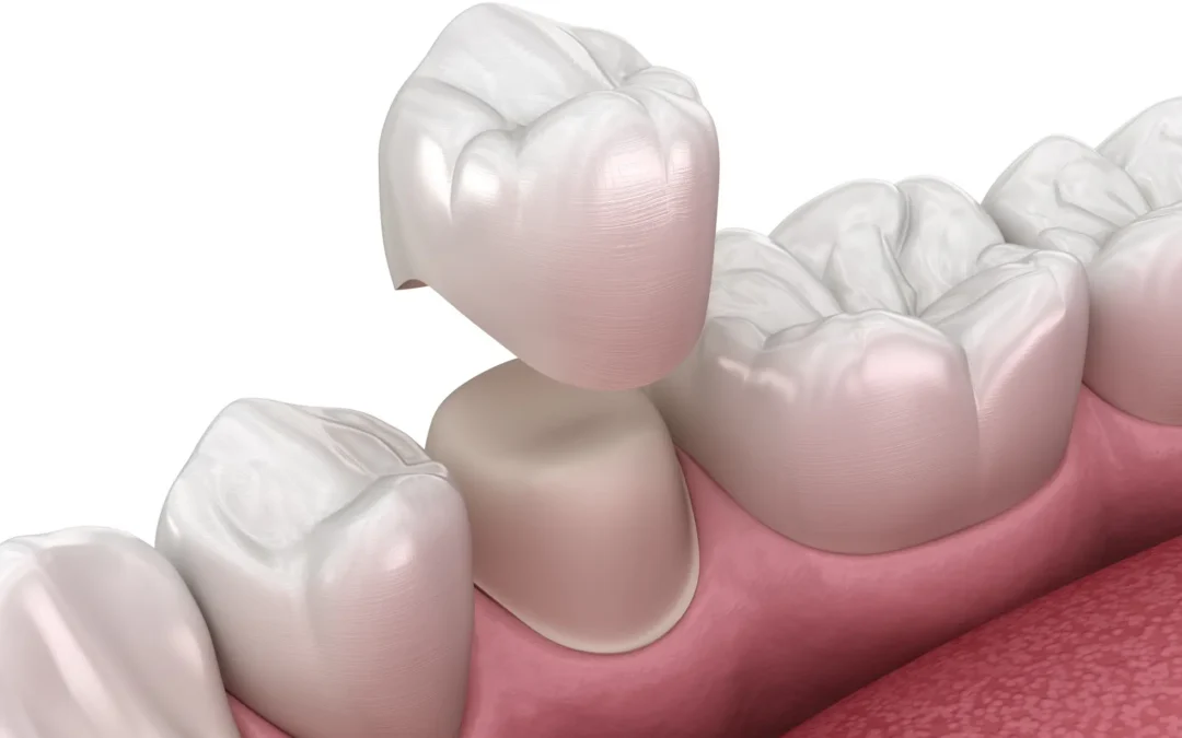 Strength & Beauty: Restoring Little Teeth with Zirconia Crowns in Baltimore